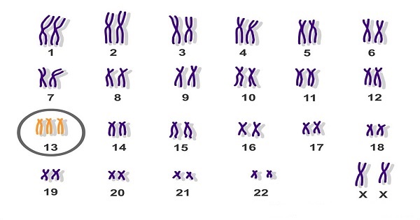 Những trẻ mắc hội chứng Patau là do trong bộ NST, cặp NST số 13 có 3 chiếc